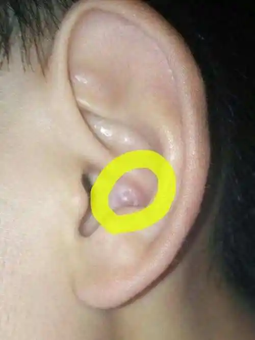 也要防止长时间压迫耳朵导致耳廓假性囊肿