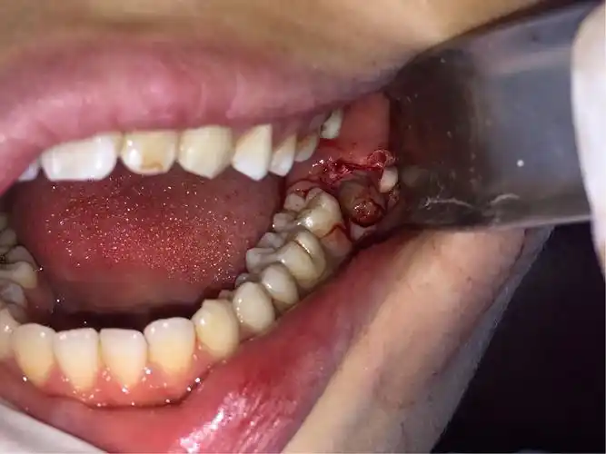 河南省口腔医院,微创拔牙一例.2017.08.16