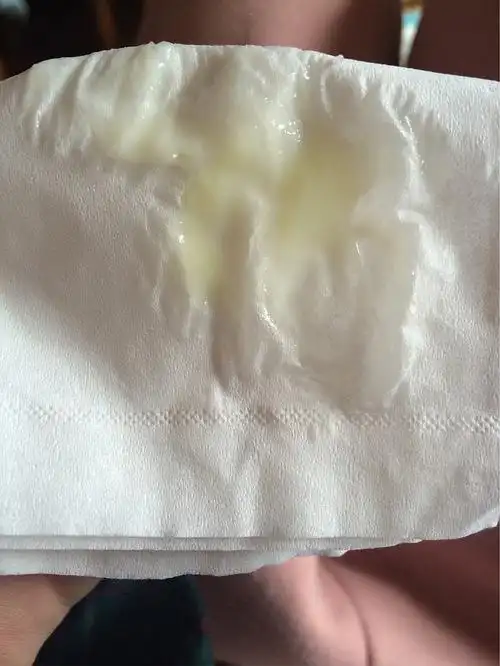 有没有人和我一样白带黄绿色脓状却治不好?