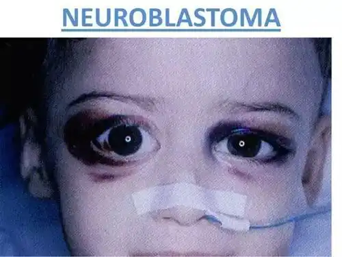 神经母细胞瘤怎么缓解疼痛