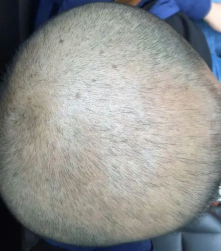 脂溢性脱发,第二份生发散,服用24天照的,推头发后17天的效果!