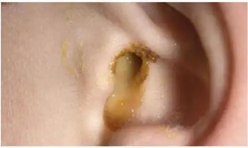 同事小南就是油耳朵,只要几天没有挖耳朵,耳朵就会有分泌物流出.