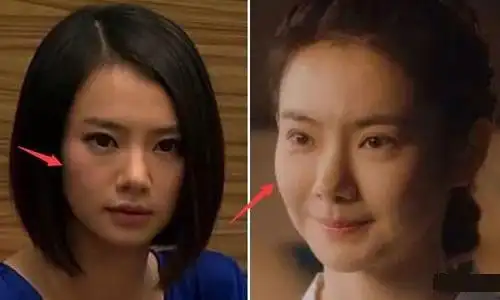 戚薇整容前后照片对比割双眼皮失败让人震惊