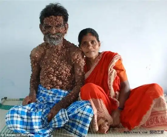 密集恐惧慎入!印度男子怪病全身"气泡"