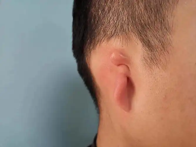 幼儿耳畸形有办法治吗?这里为大家讲解一下(上)_耳廓