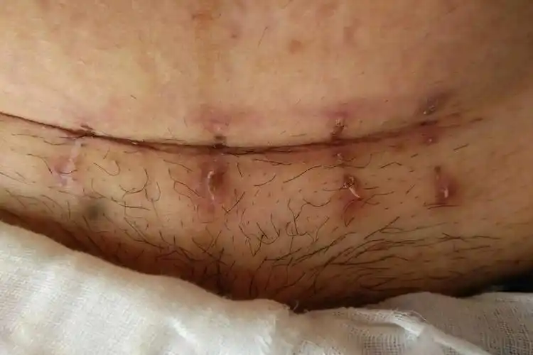 生完撕裂缝针处鼓疙瘩