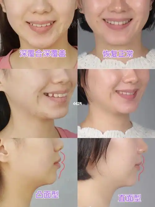 二次矫正案例|上颌前突 严重深覆盖