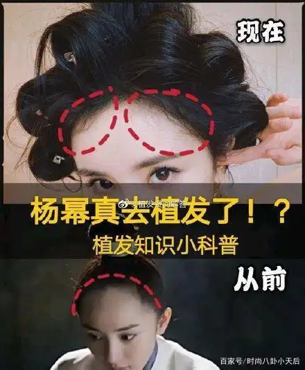 杨幂真去"植发"了吗?看前后对比图才发现,颜值巅峰是这么来的