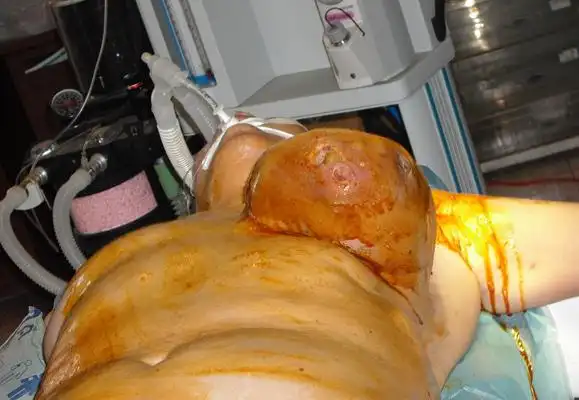 大兴乳腺癌专家_大兴治疗乳腺癌哪个专家好_大兴治疗乳腺癌最好的专家