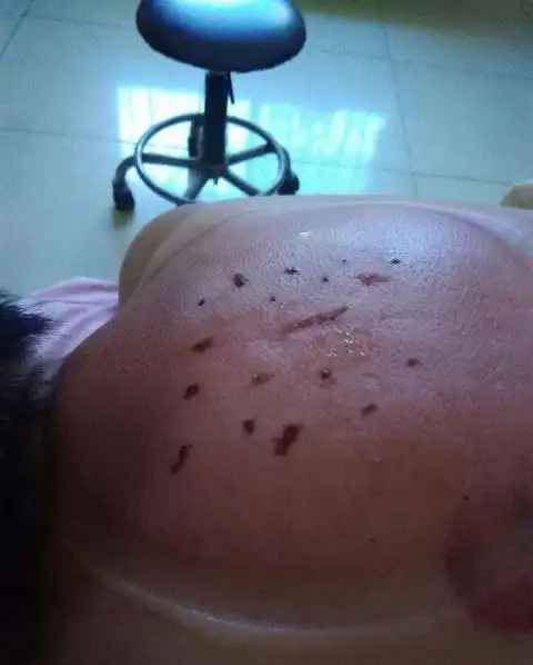 如果走罐时会出现大面积的黑紫印,则提示风寒所犯面积大;罐印数天不退