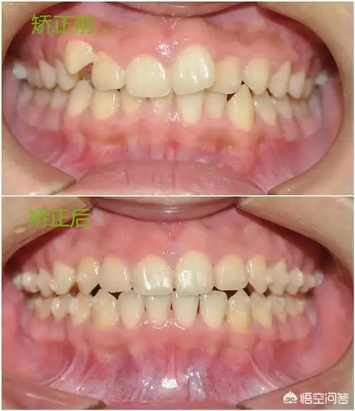 虎牙矫正的最好方法虎牙怎么矫正