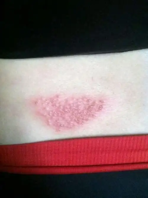 蛇盘疮外表以好,里面疼痛难忍