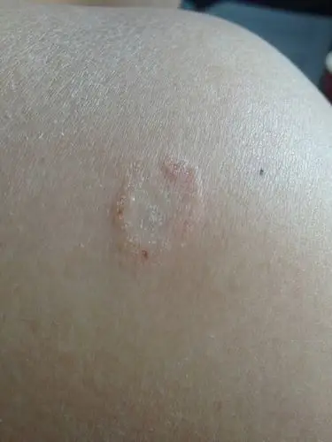 同问 今天 00:33angelaの小咩|来自手机知道|     分类:皮肤科 提问者