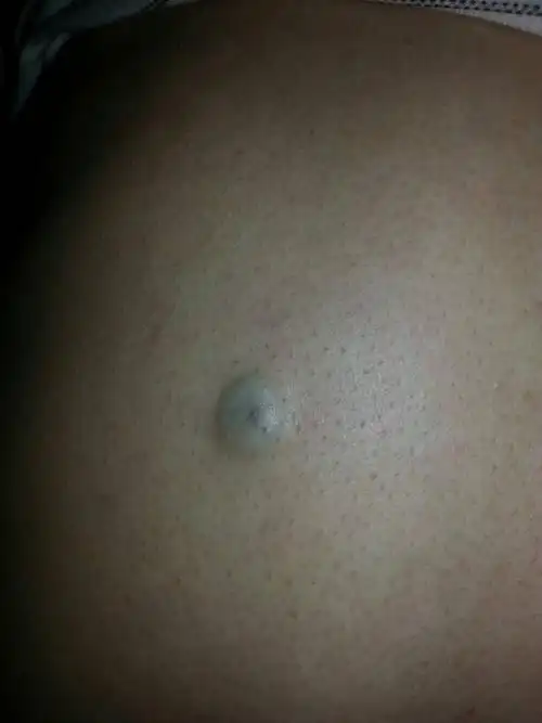 问:背上长了一个黑痘,好多年了,不痛不痒,不知道是什么原因