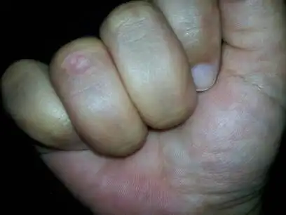 我的手指关节经常长厚厚的皮剪掉厚皮是见到一堆针状白色点,之前是一