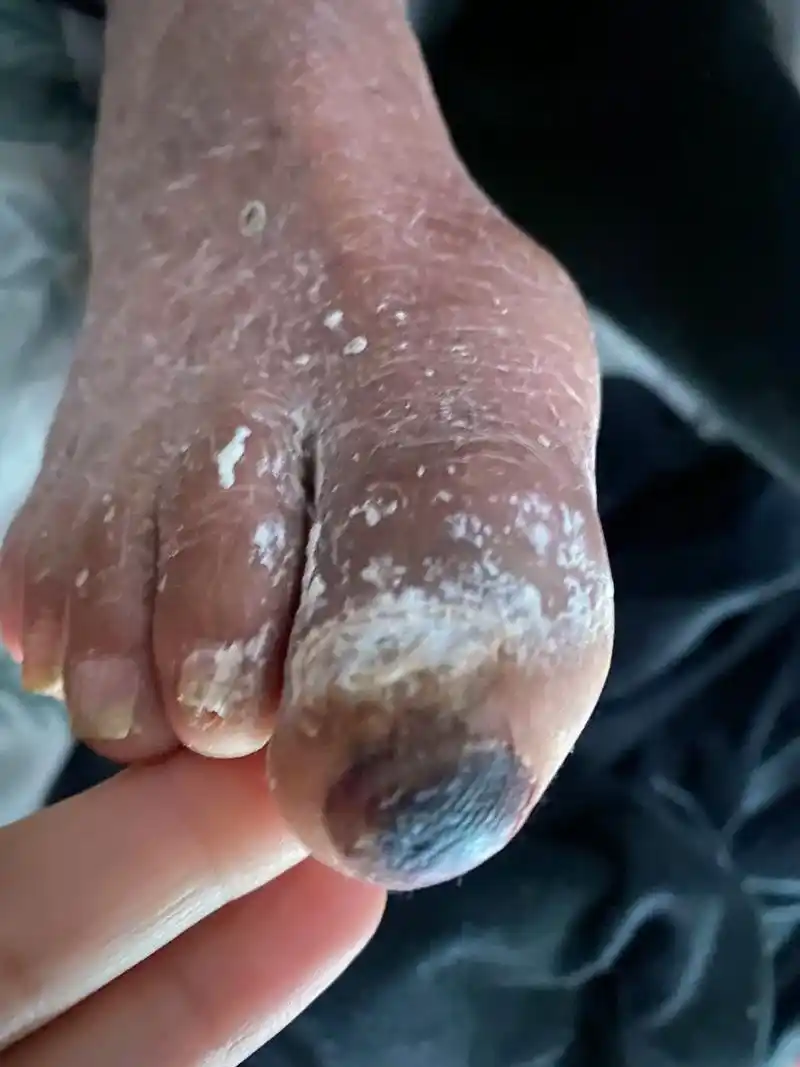 记录爸爸的糖尿病足.#足部护理 所有的付出努力辛苦都是值得的 - 抖音