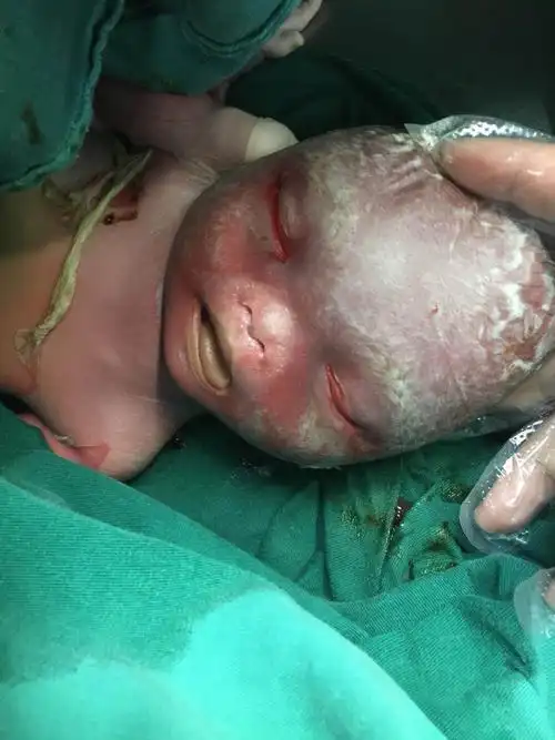 我与唐氏综合征的亲密接触