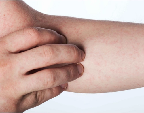 如何分辨,癌和皮肤病导致的痒?_癌症