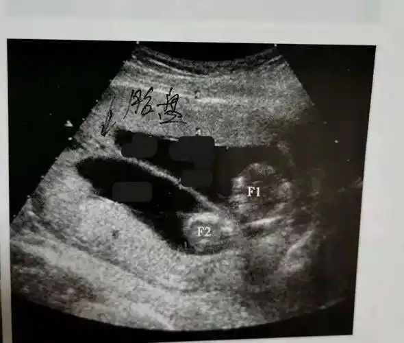 【病例分享】如此典型的轮状胎盘,看过一次就不会忘记_超声