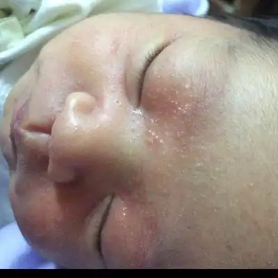 宝宝20天了,昨天脸上突然长出很多小红点,像小疱疹一样的,一片一片的