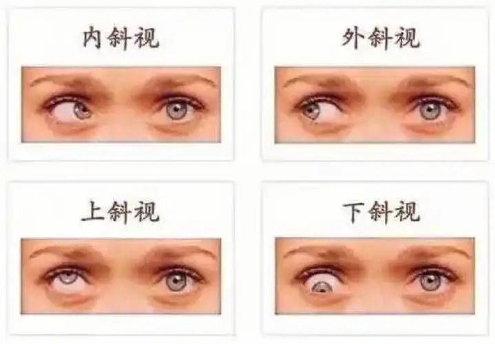 斜视训练第一步要改善视觉先学双眼运动