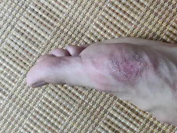 脚气脱皮,如图这个症状叫什么?