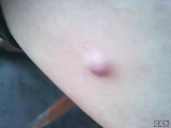 20:01:33 一17岁男生一侧大腿内侧发现有一无痛性肿块(大小约0