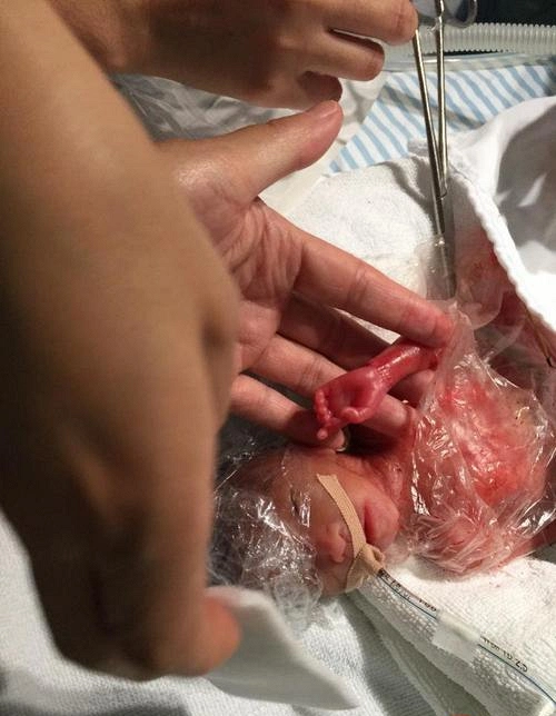 原创25周就出生的龙凤胎顺利度过难关,刚出生时才巴掌大小