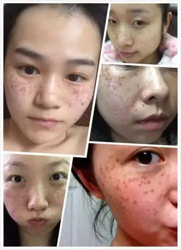 激光祛斑后反黑图片6