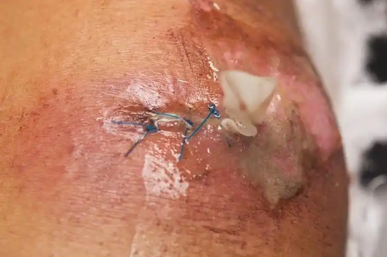 痛膝关节,在他的膝盖上被缝合的伤口