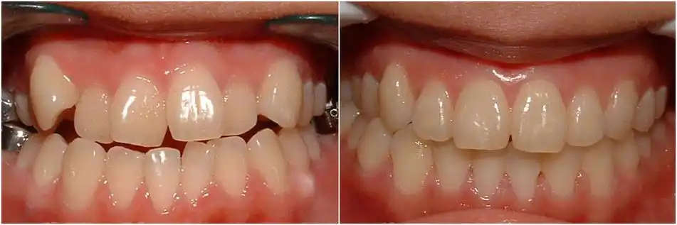 牙齿矫正要拔几颗牙顾冬辉院长为您解答