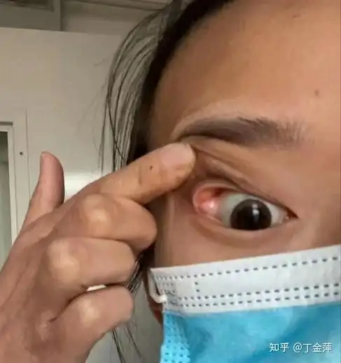 之前分享过术中泪腺脱垂的样子,术前发现的泪腺脱垂分为:轻度和严重