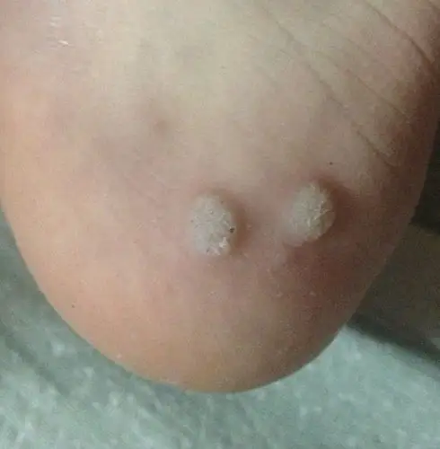 脚上起的这是什么·?鸡眼还是什么·?怎么根治