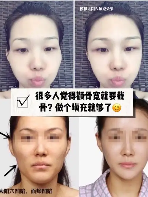 很多觉得自己颧骨宽需要截骨其实做个填充就够了