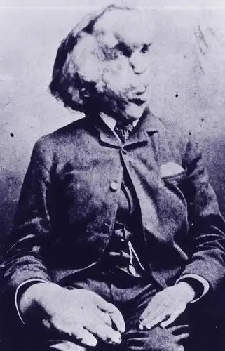 英国伦敦发现象人约瑟夫梅里克josephmerrick墓地病因至今没有定论