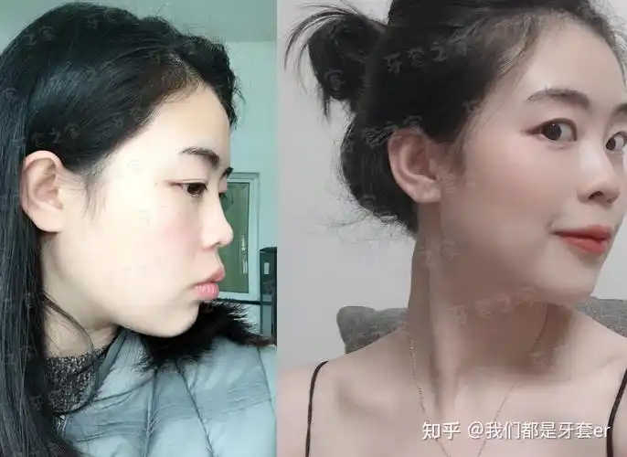 分享侧脸不好看一直想整牙但父母不赞成后来戴了牙套瘦了二十斤像换了