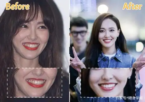 无论是凸嘴还是龅牙!原来明星靠正畸改气质