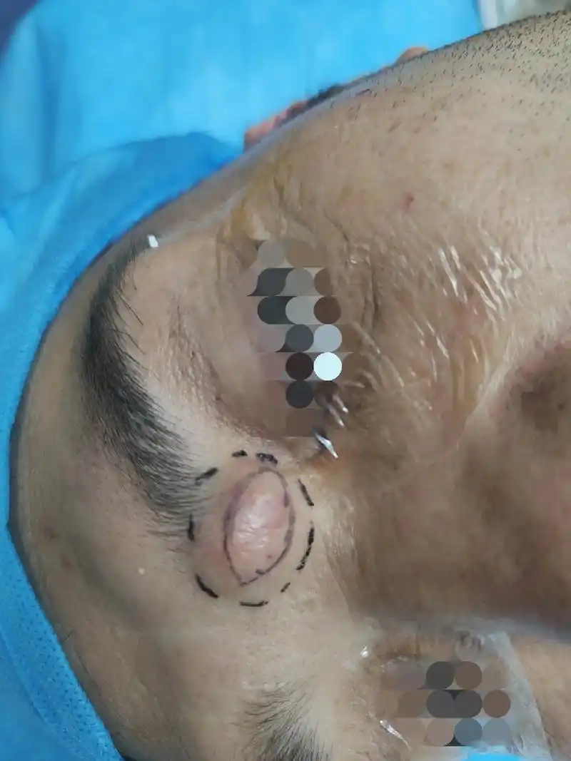 面部皮脂腺囊肿切除术#医学科普 #皮肤科 #皮脂腺囊肿 #表 - 抖音