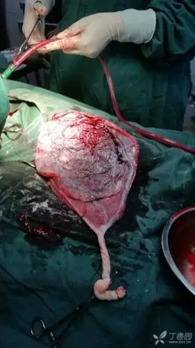 每日一图:这是什么类型的胎盘?