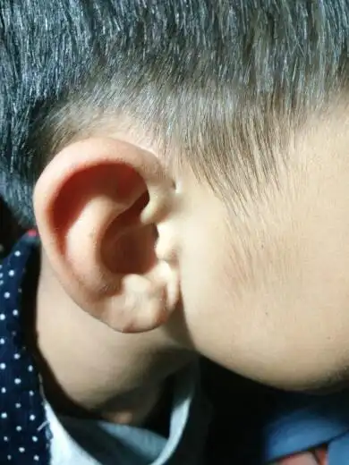邻居朋友的小孩耳朵上有个针孔大的洞,从小就有的,那是什么东西呢?