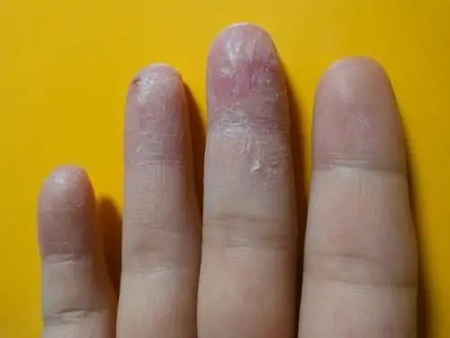 是手癣吗?