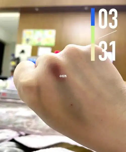 打针打的手都青了但怎么回事 不应该是在针眼位置青吗?