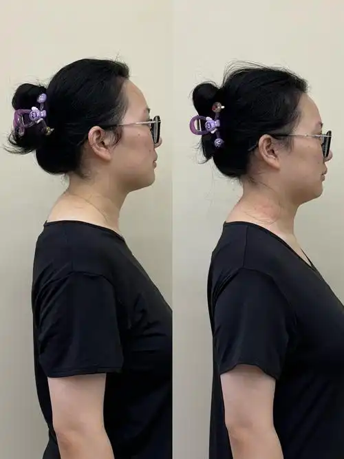 通过手法松解 训练,一节课60分钟调整富贵包前后对比图,如果勤加练习