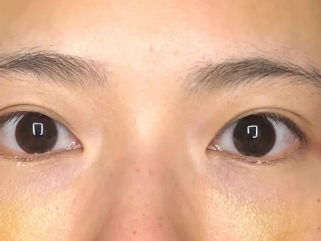 诊断:求美者泪沟凹陷明显,眼部老态明显.