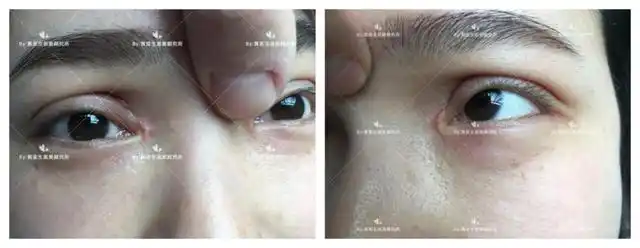 开内眼角留疤真人照片 开眼角图片
