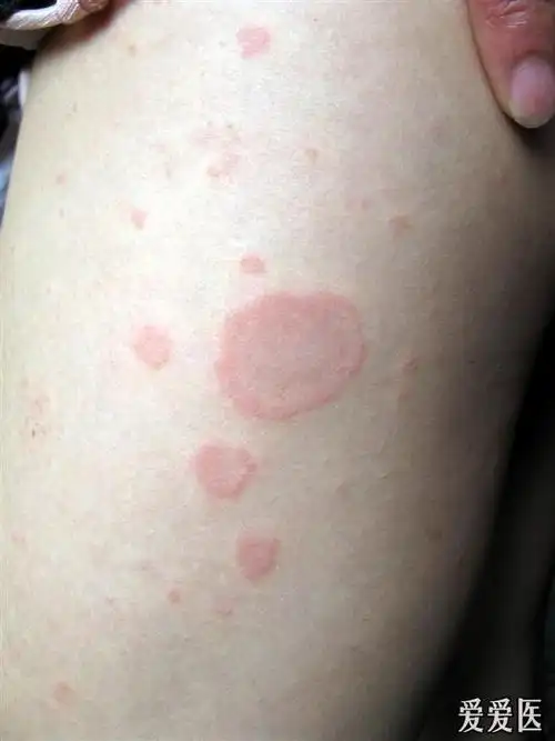 看图识病-----------远心性环状红斑 - 皮肤及性传播疾病讨论版