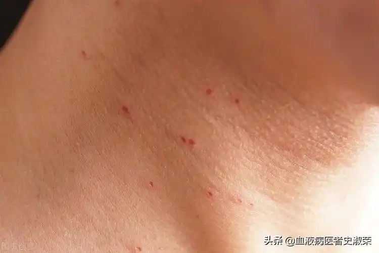 多少钱!白血病初期小红点图片"一次成功"-第1张图片-微观博客