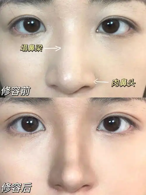新手必学教程蒜头肉鼻变身清冷感小翘鼻