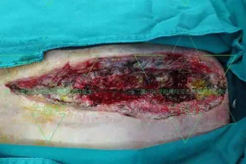 开胸后手术切口愈合不良,有救了_开胸手术_开胸手术风险 - 好大夫在线