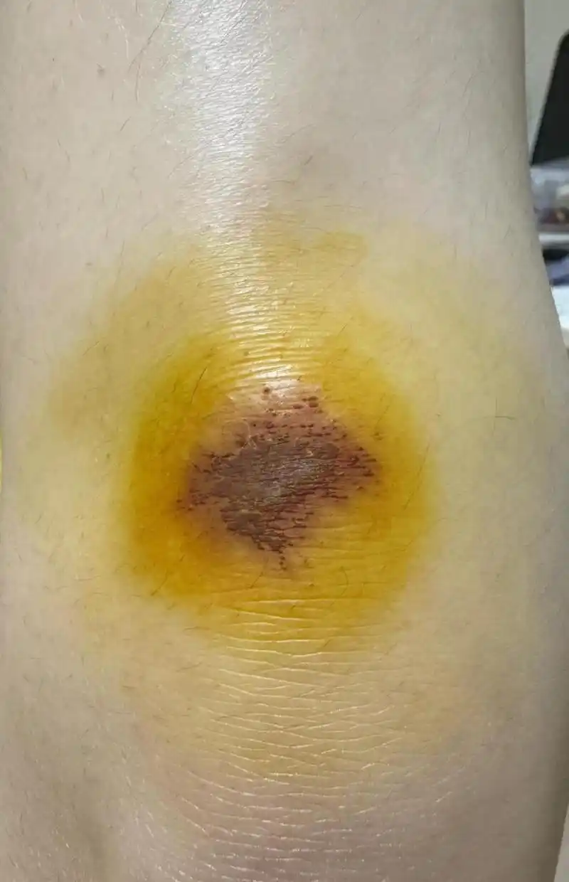 膝盖摔伤求助 请问大家能帮忙看看是长脓了吗😭我看说长脓了要把疤